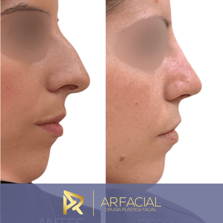 before-after
