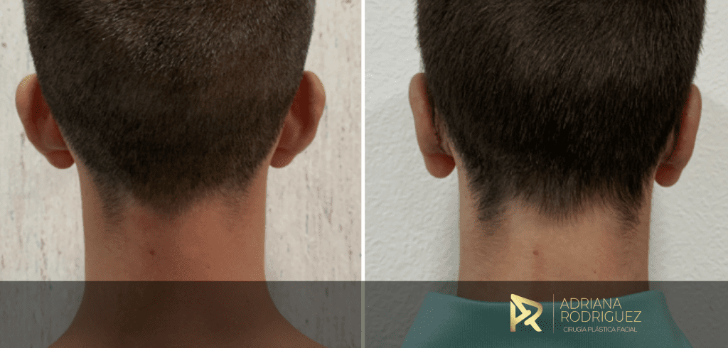 Caso real de otoplastia: vista posterior antes y después