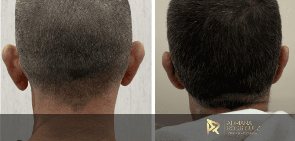 Caso real de otoplastia: vista posterior antes y después
